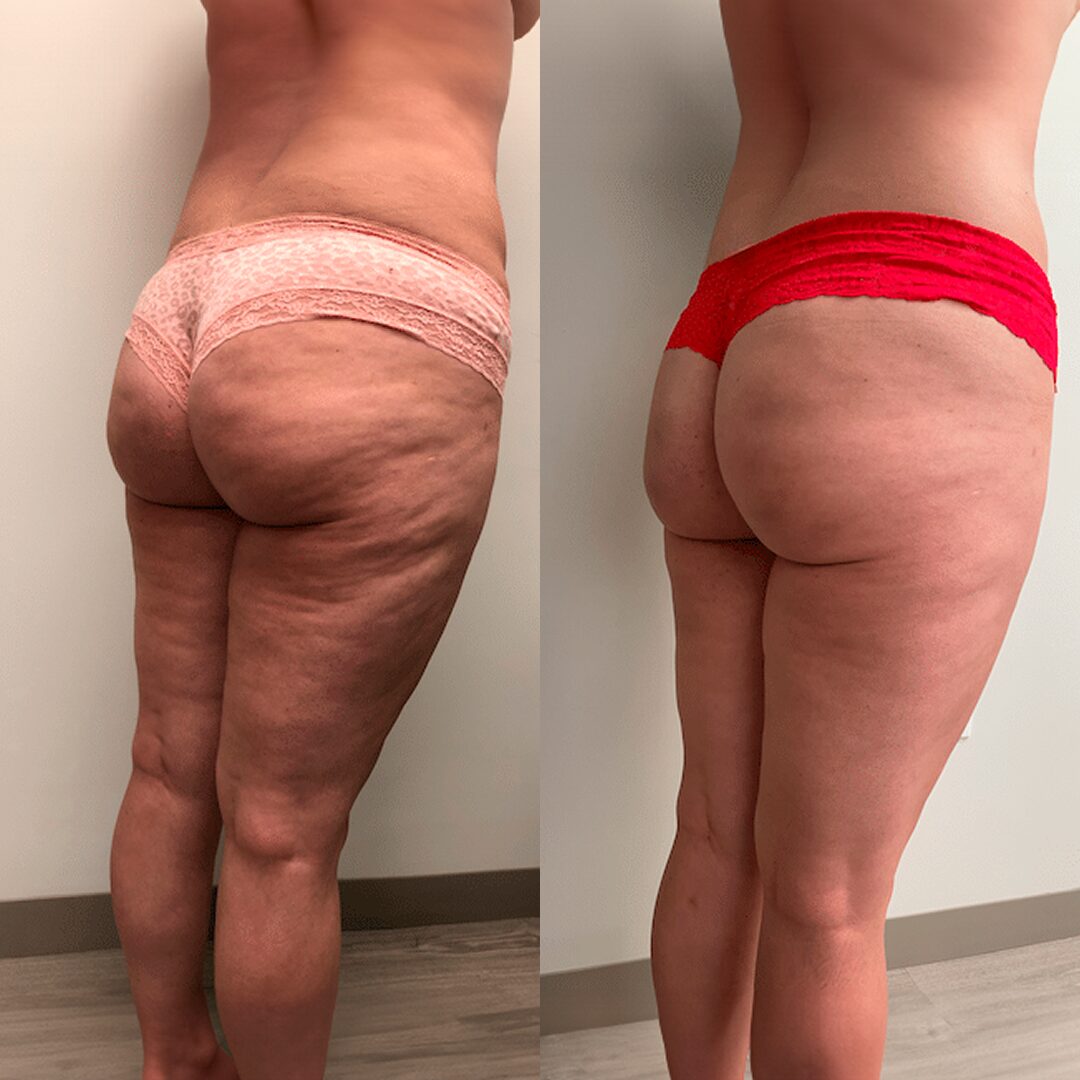 El Sculpiflex™ 3 en 1 original